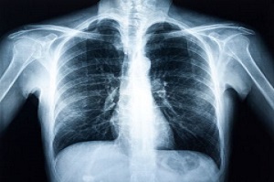 X– Ray