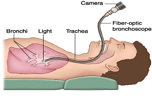 Bronchoscopy