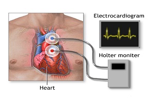 Holter Monitoring