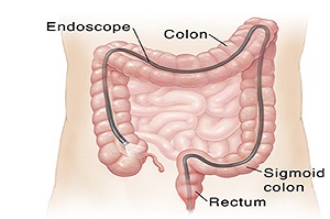 Lower G.I. Endoscopy/Colonoscopy 