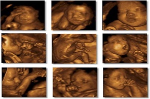 Colour Doppler Scan
