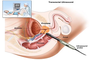 Trans – Rectal Ultrasound