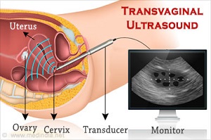 Trans – Vaginal Scan