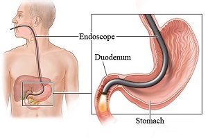 Upper G.I. Endoscopy